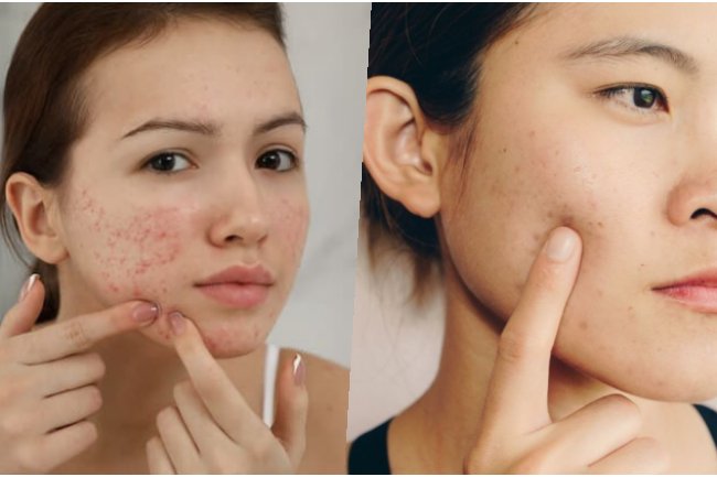 Inilah 3 Cara Paling Ampuh Menghilangkan Jerawat dengan bahan alami