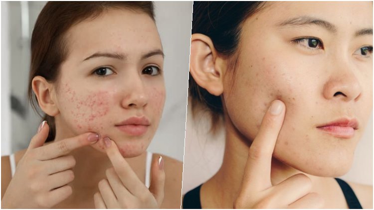 Inilah 3 Cara Paling Ampuh Menghilangkan Jerawat dengan bahan alami